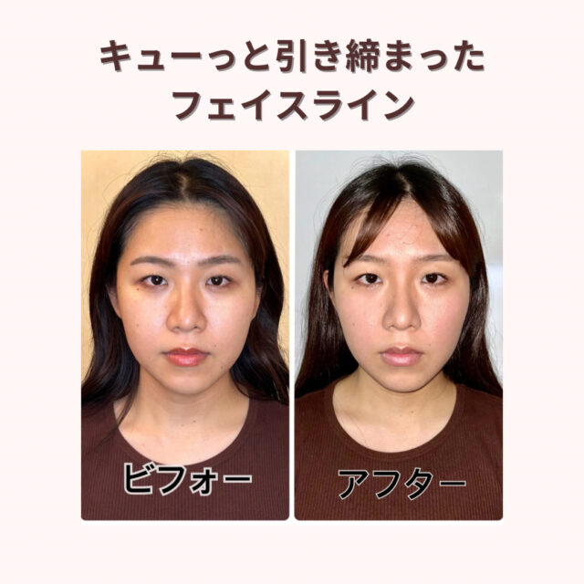 アフターは施術の翌日です。効果には個人差があります。