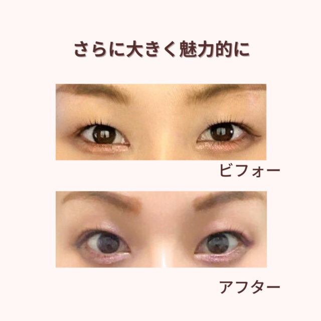 アフターは施術の翌日です。効果には個人差があります。